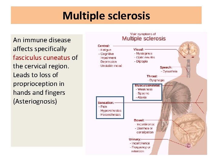 Multiple sclerosis An immune disease affects specifically fasciculus cuneatus of the cervical region. Leads