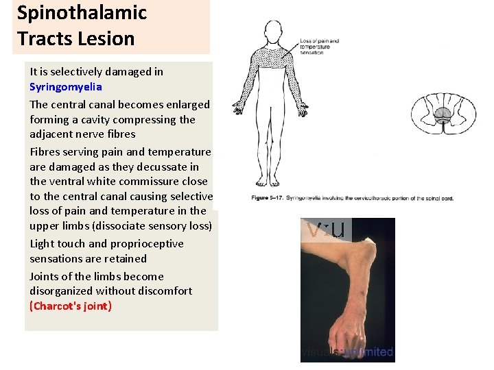 Spinothalamic Tracts Lesion It is selectively damaged in Syringomyelia The central canal becomes enlarged