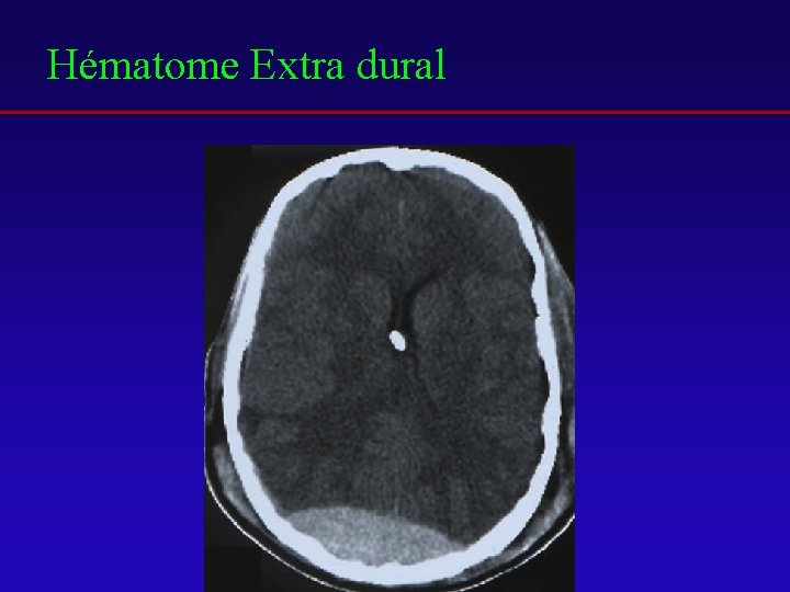 Hématome Extra dural 