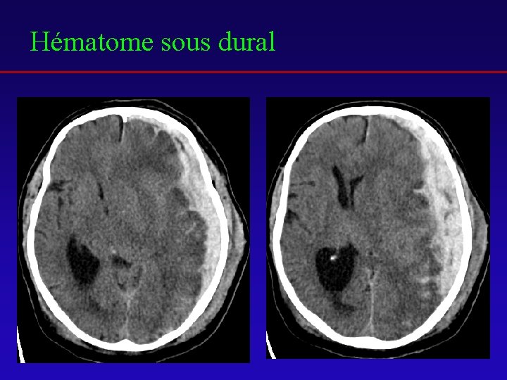 Hématome sous dural 