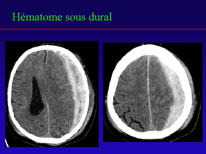 Hématome sous dural 