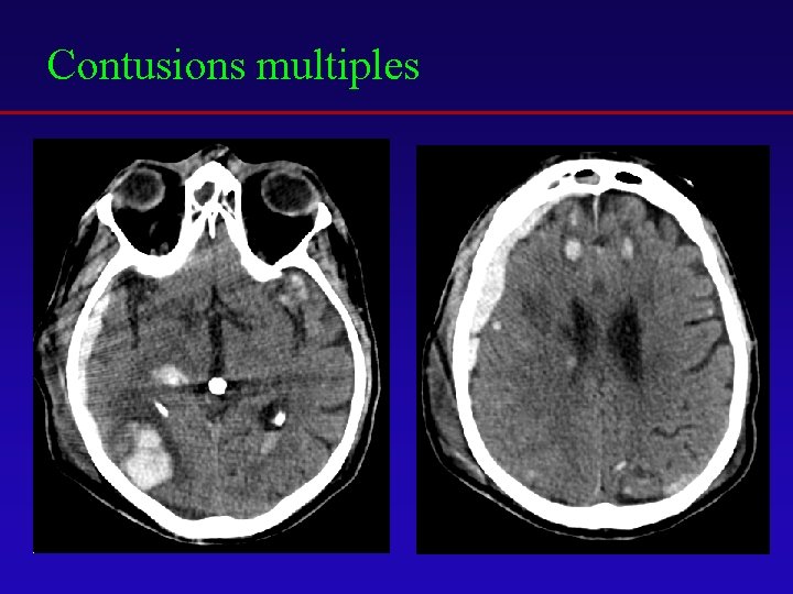 Contusions multiples 