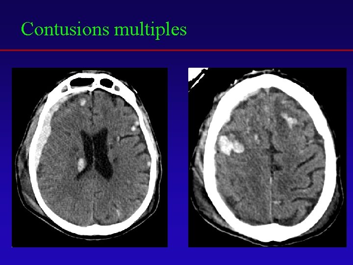 Contusions multiples 