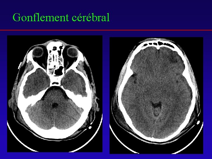 Gonflement cérébral 