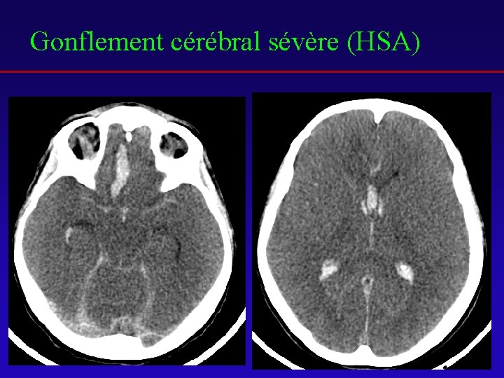 Gonflement cérébral sévère (HSA) 