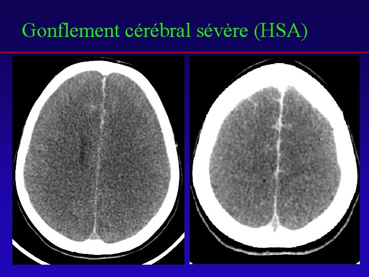 Gonflement cérébral sévère (HSA) 