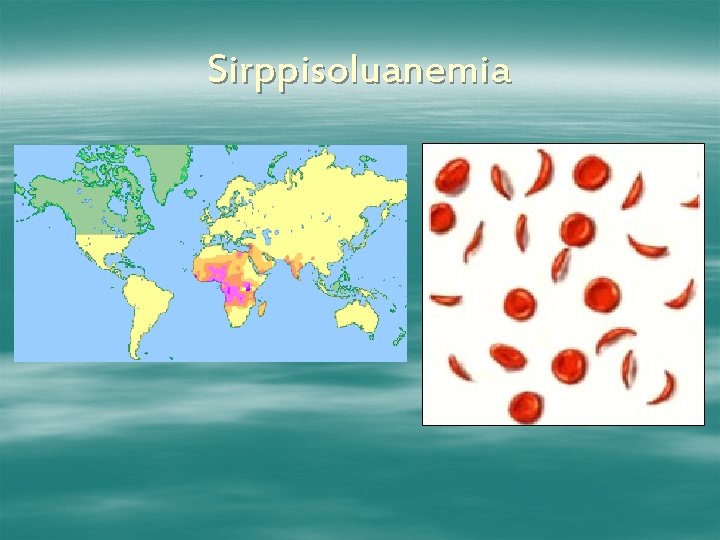 Sirppisoluanemia 