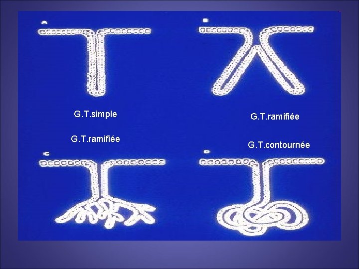 G. T. simple G. T. ramifiée G. T. contournée 