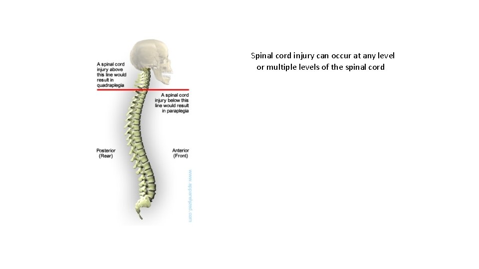 Spinal cord injury can occur at any level or multiple levels of the spinal