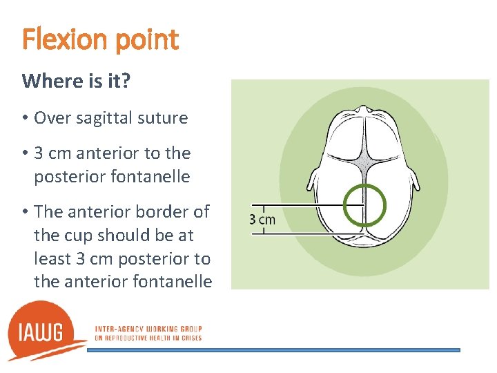 Flexion point Where is it? • Over sagittal suture • 3 cm anterior to