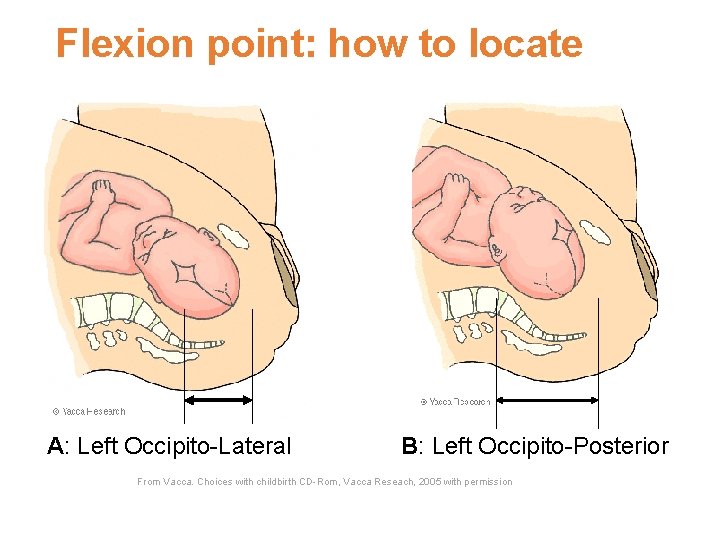 Flexion point: how to locate A: Left Occipito-Lateral B: Left Occipito-Posterior From Vacca. Choices