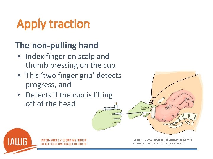 Apply traction The non-pulling hand • Index finger on scalp and thumb pressing on