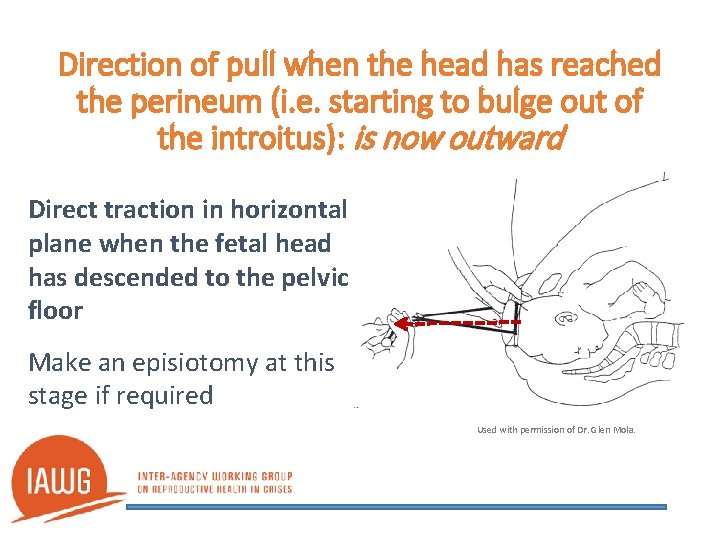 Direction of pull when the head has reached the perineum (i. e. starting to
