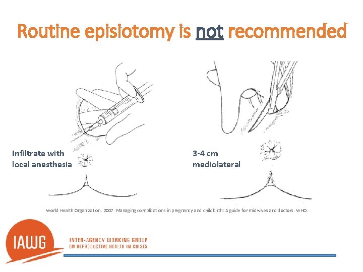 Routine episiotomy is not recommended Infiltrate with local anesthesia 3 -4 cm mediolateral World