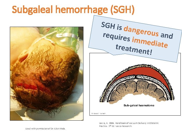 Subgaleal hemorrhage (SGH) SGH is d angerou s and require s imme d iate