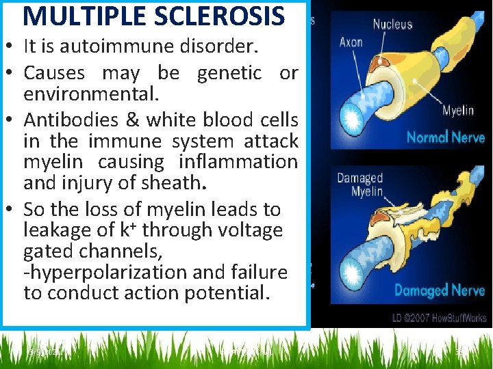  MULTIPLE SCLEROSIS • It is autoimmune disorder. • Causes may be genetic or