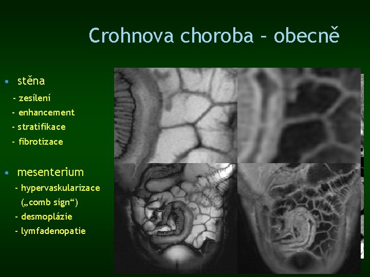 Crohnova choroba – obecně • stěna - zesílení - enhancement - stratifikace - fibrotizace