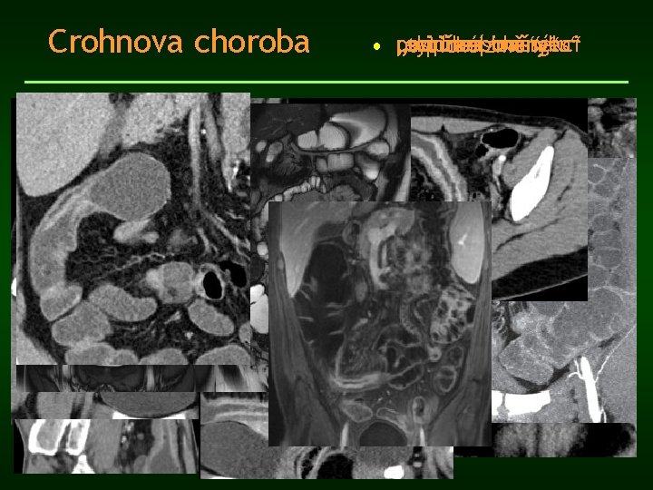 Crohnova choroba • „minimal „skip leasions“ postižení recidiva po tračníku changes“ resekci „typické změny“