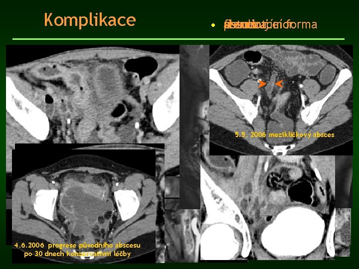 Komplikace • absces stenozující forma pseudotumor fistulizace 5. 5. 2006 mezikličkový absces 4. 6.