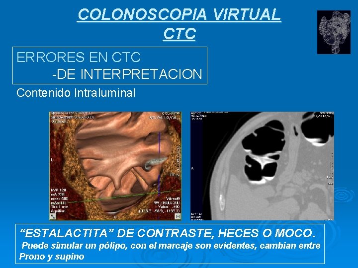 COLONOSCOPIA VIRTUAL CTC ERRORES EN CTC -DE INTERPRETACION Contenido Intraluminal “ESTALACTITA” DE CONTRASTE, HECES