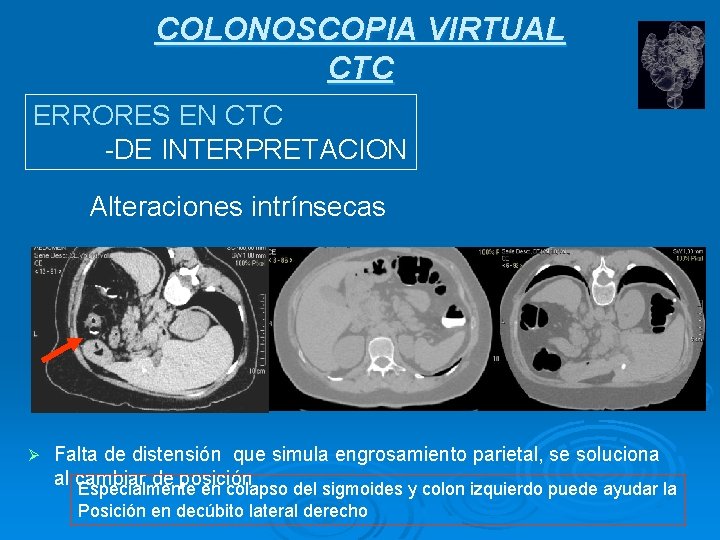 COLONOSCOPIA VIRTUAL CTC ERRORES EN CTC -DE INTERPRETACION Alteraciones intrínsecas Ø Falta de distensión
