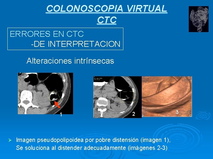 COLONOSCOPIA VIRTUAL CTC ERRORES EN CTC -DE INTERPRETACION Alteraciones intrínsecas 1 Ø 2 Imagen