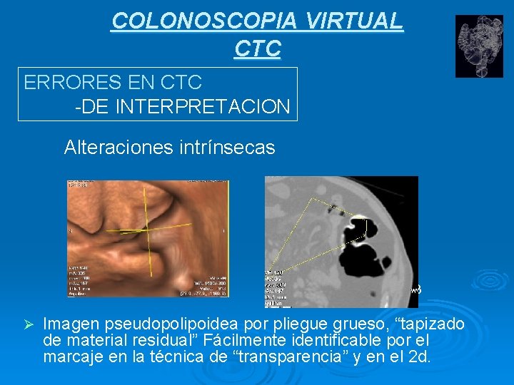 COLONOSCOPIA VIRTUAL CTC ERRORES EN CTC -DE INTERPRETACION Alteraciones intrínsecas 1 2 Ø 3