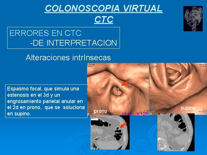 COLONOSCOPIA VIRTUAL CTC ERRORES EN CTC -DE INTERPRETACION Alteraciones intrínsecas Espasmo focal, que simula