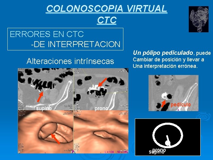 COLONOSCOPIA VIRTUAL CTC ERRORES EN CTC -DE INTERPRETACION Un pólipo pediculado, puede Alteraciones intrínsecas