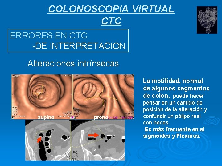COLONOSCOPIA VIRTUAL CTC ERRORES EN CTC -DE INTERPRETACION Alteraciones intrínsecas La motilidad, normal de