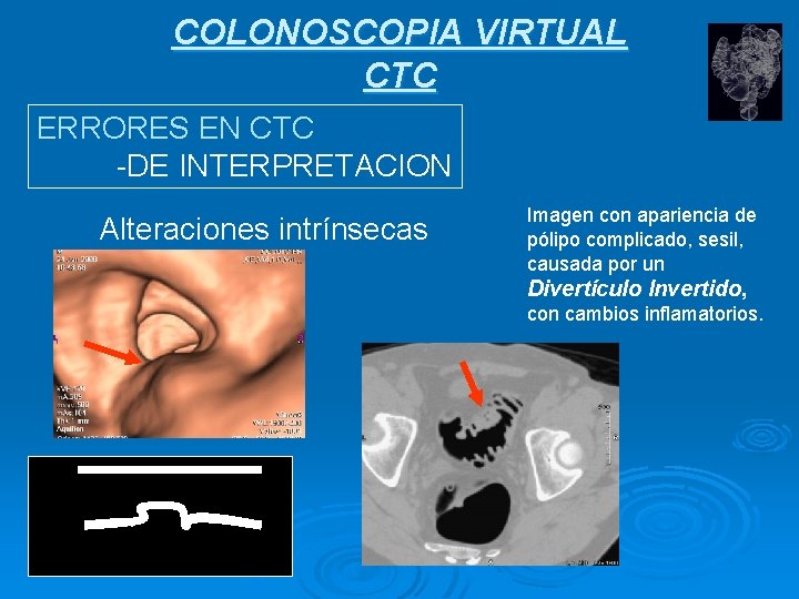 COLONOSCOPIA VIRTUAL CTC ERRORES EN CTC -DE INTERPRETACION Alteraciones intrínsecas Imagen con apariencia de