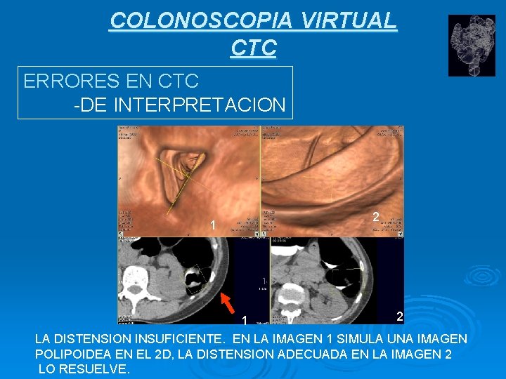 COLONOSCOPIA VIRTUAL CTC ERRORES EN CTC -DE INTERPRETACION 1 2 2 1 LA DISTENSION