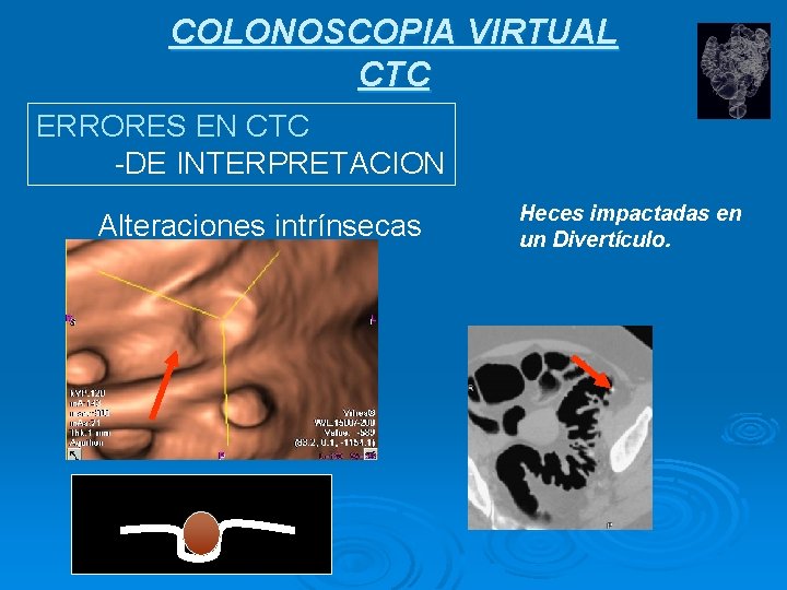 COLONOSCOPIA VIRTUAL CTC ERRORES EN CTC -DE INTERPRETACION Alteraciones intrínsecas Heces impactadas en un