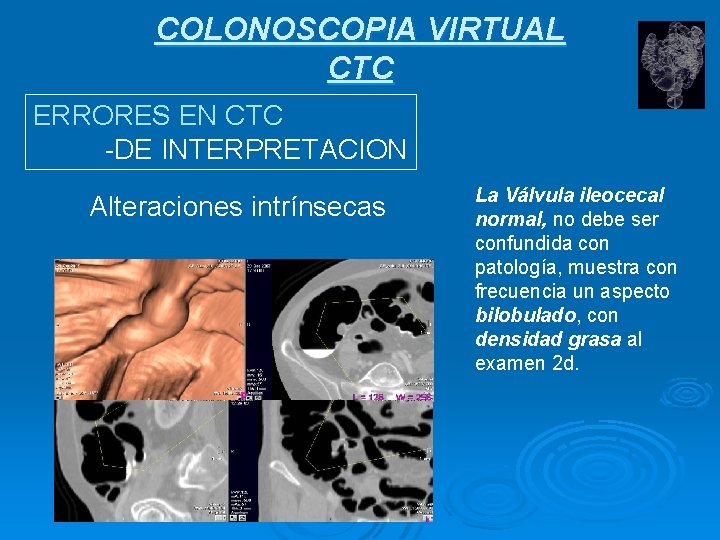 COLONOSCOPIA VIRTUAL CTC ERRORES EN CTC -DE INTERPRETACION Alteraciones intrínsecas La Válvula ileocecal normal,