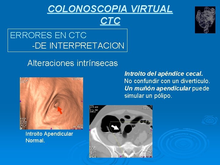 COLONOSCOPIA VIRTUAL CTC ERRORES EN CTC -DE INTERPRETACION Alteraciones intrínsecas Introito del apéndice cecal.