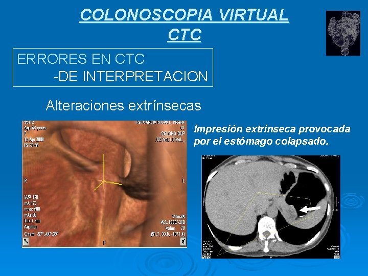 COLONOSCOPIA VIRTUAL CTC ERRORES EN CTC -DE INTERPRETACION Alteraciones extrínsecas Impresión extrínseca provocada por