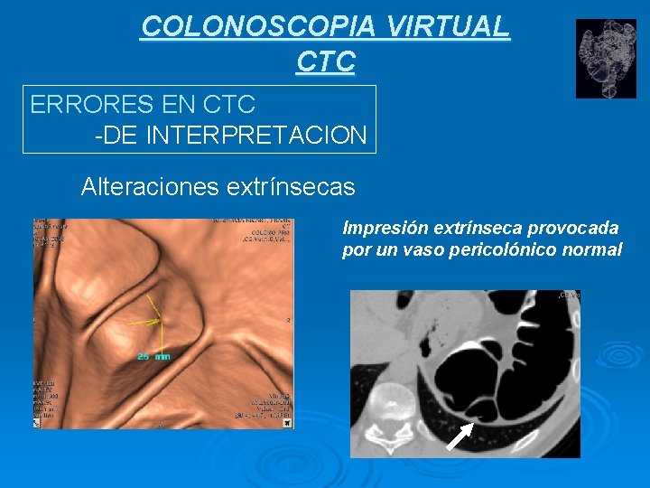 COLONOSCOPIA VIRTUAL CTC ERRORES EN CTC -DE INTERPRETACION Alteraciones extrínsecas Impresión extrínseca provocada por