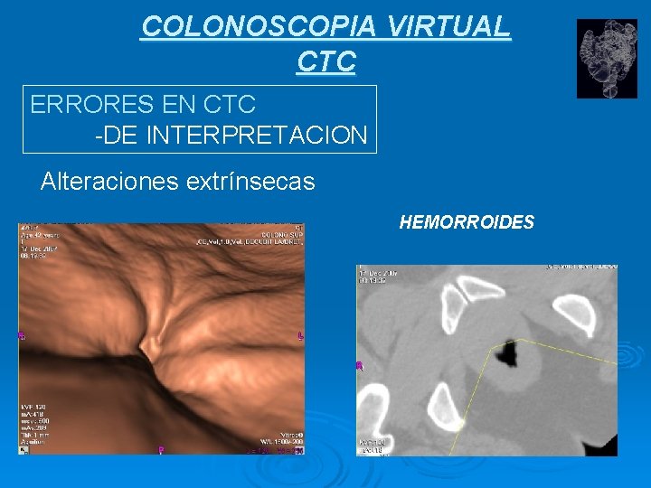 COLONOSCOPIA VIRTUAL CTC ERRORES EN CTC -DE INTERPRETACION Alteraciones extrínsecas HEMORROIDES 