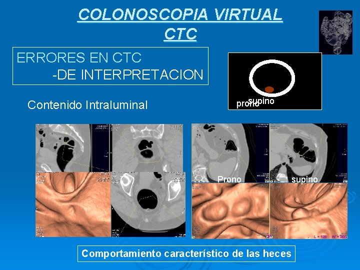 COLONOSCOPIA VIRTUAL CTC ERRORES EN CTC -DE INTERPRETACION Contenido Intraluminal supino prono Prono supino