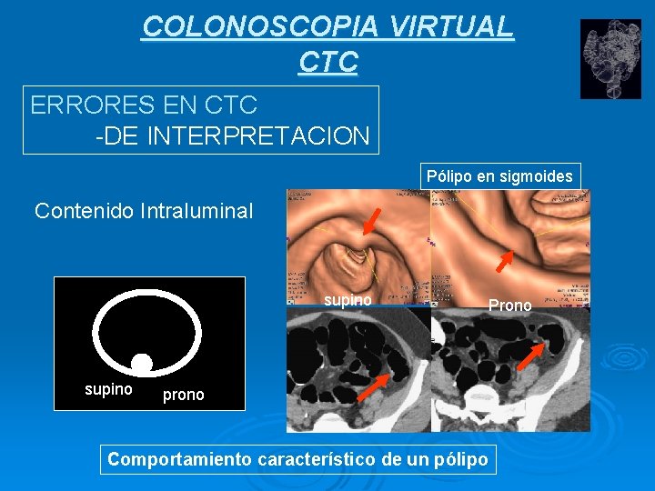 COLONOSCOPIA VIRTUAL CTC ERRORES EN CTC -DE INTERPRETACION Pólipo en sigmoides Contenido Intraluminal supino