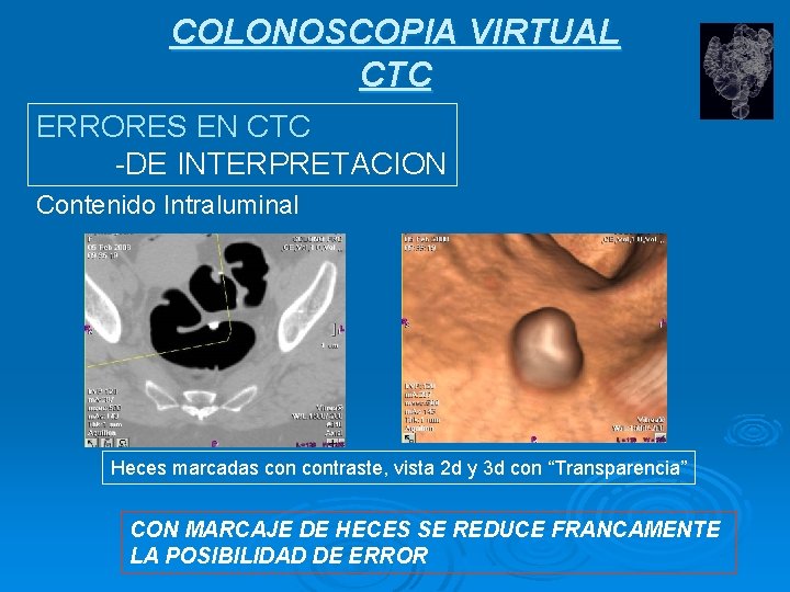 COLONOSCOPIA VIRTUAL CTC ERRORES EN CTC -DE INTERPRETACION Contenido Intraluminal Heces marcadas contraste, vista