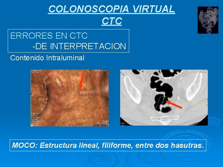 COLONOSCOPIA VIRTUAL CTC ERRORES EN CTC -DE INTERPRETACION Contenido Intraluminal MOCO: Estructura lineal, filiforme,