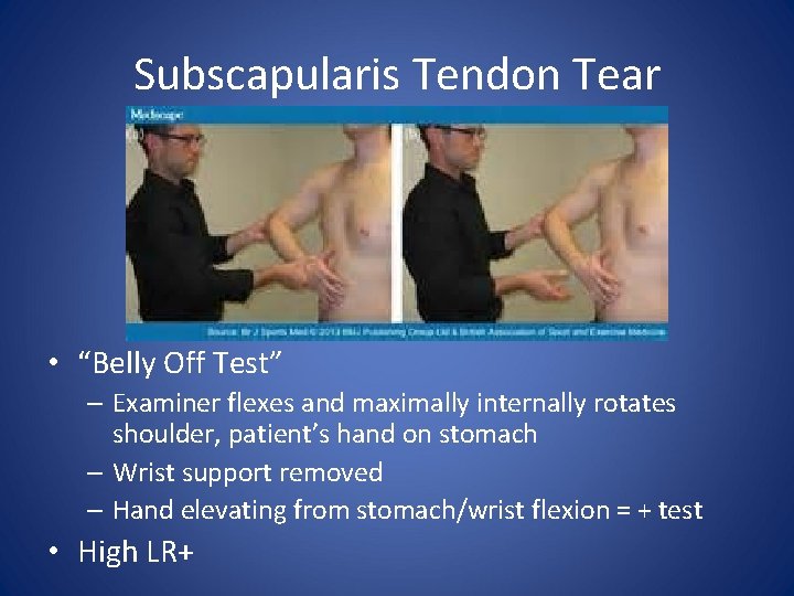 Subscapularis Tendon Tear • “Belly Off Test” – Examiner flexes and maximally internally rotates