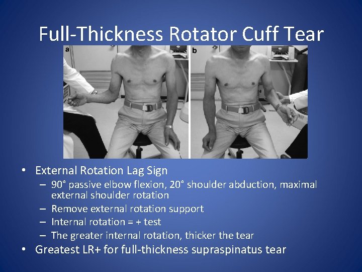 Full-Thickness Rotator Cuff Tear • External Rotation Lag Sign – 90° passive elbow flexion,