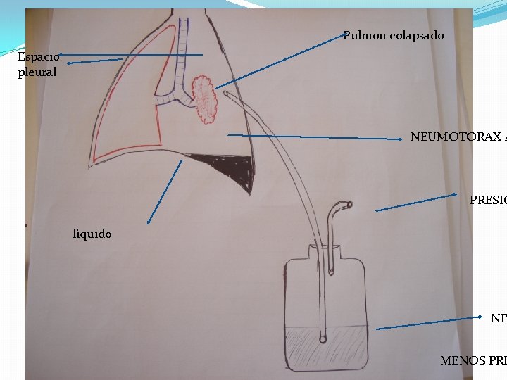 Pulmon colapsado Espacio pleural NEUMOTORAX A PRESIO liquido NIV MENOS PRE 