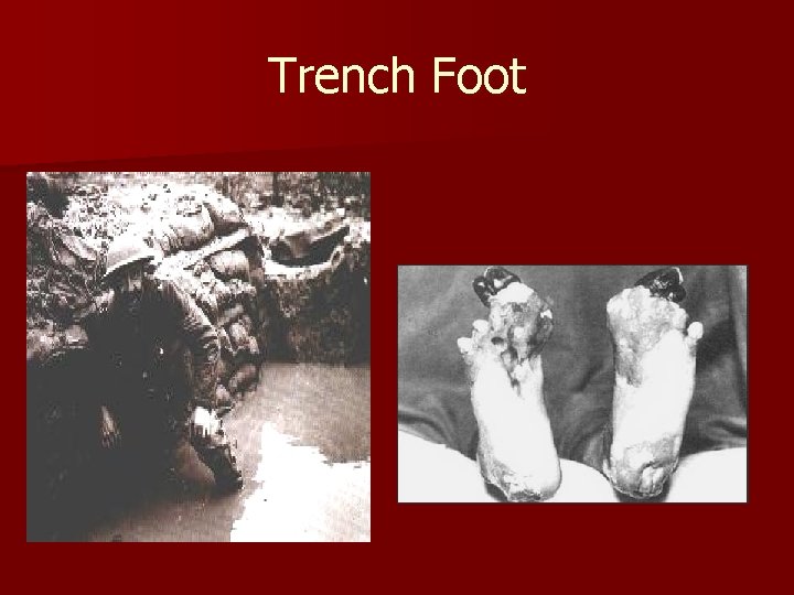 Trench Foot 