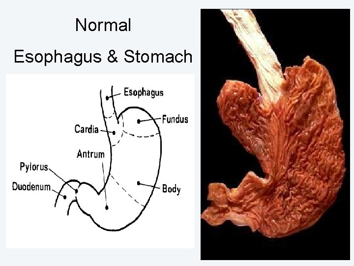 Normal Esophagus & Stomach 