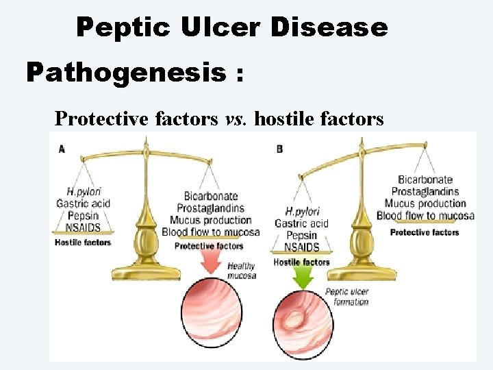 Peptic Ulcer Disease Pathogenesis : Protective factors vs. hostile factors 