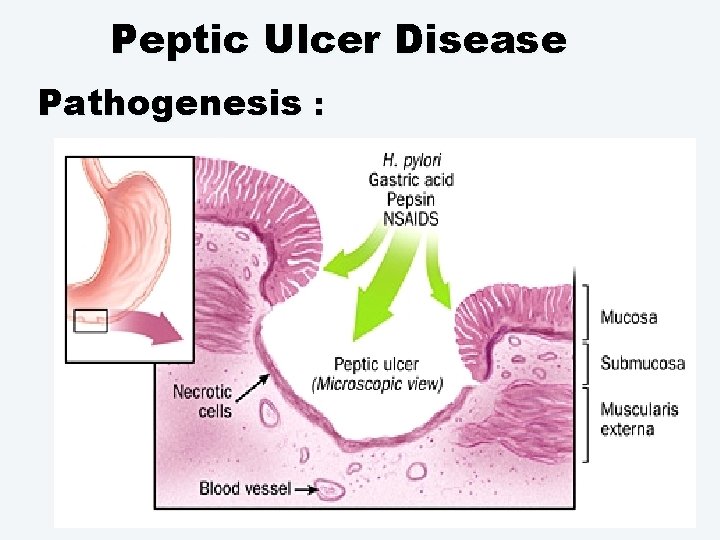 Peptic Ulcer Disease Pathogenesis : 