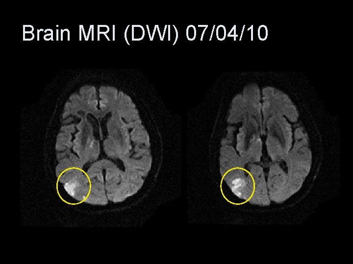 Brain MRI (DWI) 07/04/10 